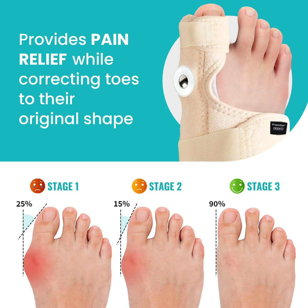 Promifun Bunion Corrector Adjustable Toe Splint Pain Relief Beige 1Pair One Size