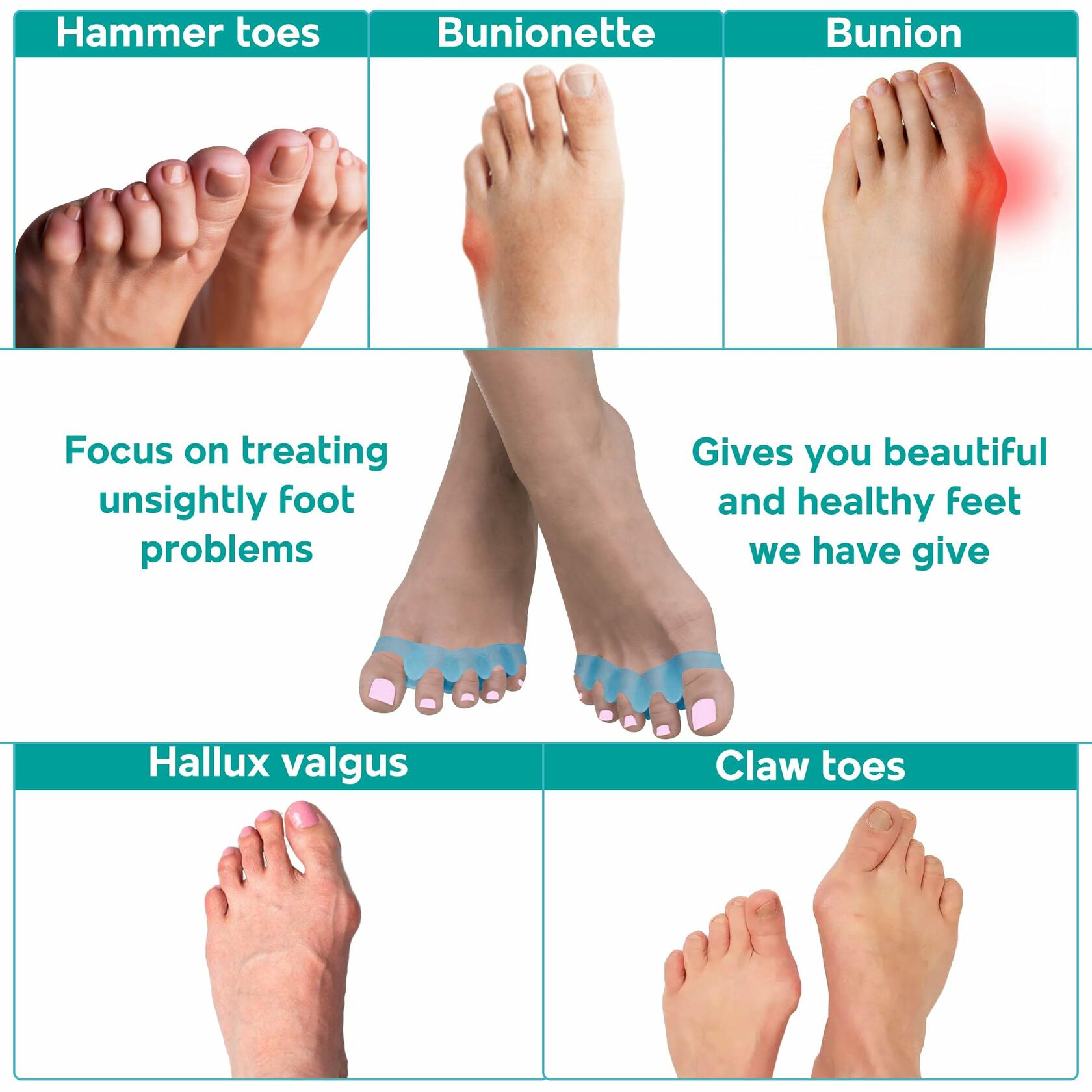 NAMELESS NICHE Toe Separators Bunion Corrector Toe Spacers Pink 1 Pair